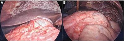 Malignant peritoneal mesothelioma presenting with bilateral hydronephrosis and renal insufficiency: a case report and literature review
